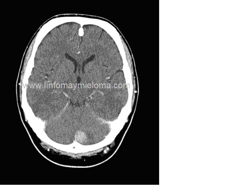 TAC craneal. Linfoma secundario